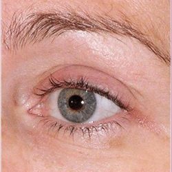 Thermage Before & After Patient #1591
